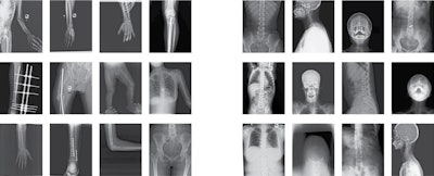 Example of valid (left) vs outlier (right) x-ray images. All the scans were manually filtered based on the parts of the body present in the scan, clarity of the scans, and resolution. The scans containing only arm, shoulder, leg, and hip regions were accepted. Image and caption courtesy of Scientific Data through CC BY 4.0.