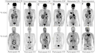 (A-F) Representative F-18 FDG and F-18 FAPI-PET/CT scans for six study participants with lung cancer. F-18 FAPI and F-18 FDG-PET/CT images show that uptake occurred in granulomatous lymph nodes (LNs) (false-positive nodes; participant number 4, A); F-18 FAPI- PET/CT outperformed F-18 FDG-PET/CT in detecting liver metastases (participant number 21, B) and mediastinal LN metastases (participants number 22, C; 30, D; and 54, E); and F-18 FAPI- PET/CT outperformed F-18 FDG-PET/CT in detecting bone metastases (participant number 27, F). White arrows indicate foci. Image and caption courtesy of the RSNA.