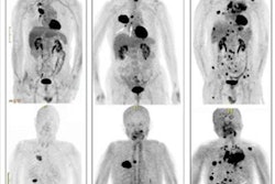2023 08 08 19 48 5185 2023 08 09 Fapi Lung Cancer 20230808190246