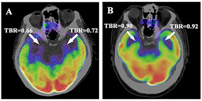 Axial views of the amygdala. Higher amygdalar uptake of F-18 FDG in a patient who died (A) compared with a patient who survived (B) after a diagnosis of head and neck cancer. These images were recorded at the initial cancer staging prior to cancer treatment. Both individuals had the same stage and type of cancer. Image courtesy of PLOS One.