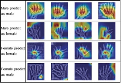 Grad-CAM visualizations for estimates from InceptionResNetV2 for estimating sex from hand x-rays. Image courtesy of Forensic Science International: Reports through CC BY 4.0.