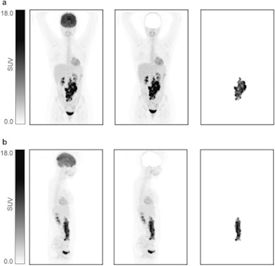 Illustration of the different maximum intensity projections (MIPs) implemented in the study. (a) Coronal view. (b) Sagittal view. From left to right: MIP, MIP without brain, and lesion MIP. Image and caption courtesy of Scientific Reports through CC BY 4.0.
