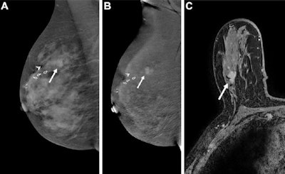 CEM images (A, B) and an MRI scan (C) show true-positive findings in a 73-year-old woman with a personal history of right breast ductal carcinoma in situ (DCIS) treated with lumpectomy and newly diagnosed left breast invasive lobular carcinoma (not shown), who presented for contralateral right breast screening. (A) Mediolateral oblique low-energy and (B) mediolateral oblique recombined CEMs of the right breast show an irregular contrast-enhanced mass with irregular margins in the upper outer quadrant (arrows). (C) Axial contrast-enhanced breast MRI sequence shows an irregular contrast-enhanced mass with irregular margins that is suspicious for cancer in the upper outer quadrant of the right breast (arrow). Pathology revealed recurrent invasive ductal carcinoma and DCIS, Nottingham grade I, that was estrogen receptor positive, progesterone receptor positive, and human epidermal growth factor receptor 2 (HER2) receptor negative. Images courtesy of RSNA.