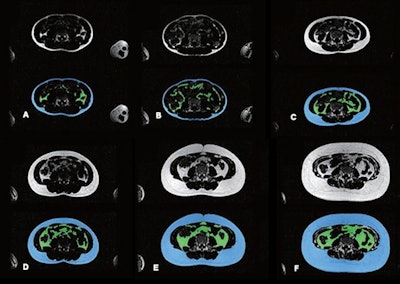 Example results show automated abdominal adipose tissue segmentation into SAT and VAT using Dixon MRI acquisitions in different children. In each image, top and bottom images represent fat-only images without (top) and with (bottom) segmentation. Blue areas denote SAT, and green area denotes VAT. Images A-F represent six children with varying body sizes and varying amounts of abdominal SAT and VAT. Images courtesy of ARRS.