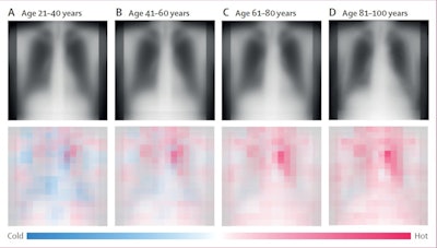 Saliency maps from the external test dataset. Average saliency images of each 20-year chronological age group in the external test dataset from institution C. The top panels show averaged chest radiographs for all participants in the group and the bottom panels show averaged saliency maps. Hot areas in the saliency maps indicate characteristics of increasing age in chest radiographs; cold areas indicate characteristics of decreasing age. Image and caption courtesy of the Lancet Healthy Longevity through CC BY 4.0.