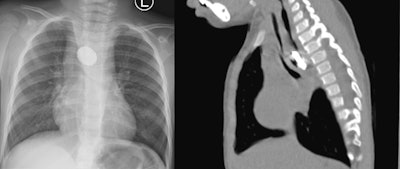 Posteroanterior chest x-ray and sagittal view of the thoracic CT revealing a foreign body in the thoracic esophagus. Image courtesy of the International Journal of Surgery Case Reports through CC BY 4.0.