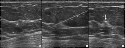 Ultrasound-guided Magseed localization of a nonpalpable lesion. (A) target lesion, (B) Magseed needle introducer (asterisks), (C) Magseed in situ (arrow). Images courtesy of Clinical Breast Cancer. Licensed under CC BY 4.0.