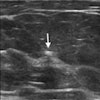 2023 08 22 20 06 8280 2023 08 22 Cbc Breast Ultrasound Mag Seeds 20230822203019