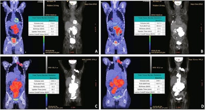 Pre-leukapheresis (pre-leuk) and pre-lymphodepletion chemotherapy (pre-LD) coronal fused PET/CT (left) and maximum projection image (right) PET/CT imaging and total tumor volumetric analysis for two patients. The first patient A, B had both increasing extranodal metabolic tumor volume (MTV) and increasing total lesion glycolysis (TLG) of the largest lesion (risk score 2) from pre-leuk A to pre-LD B, and experienced progressive disease and death after CAR-T infusion. The second patient C, D had neither risk factor (risk score 0), is alive and without progression at last follow-up, despite having higher MTV and TLG at each individual time point compared to the first patient. Image and caption courtesy of the Blood Cancer Journal through CC BY 4.0.