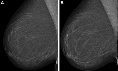 Full-field digital mammograms (right mediolateral oblique view) in a 59-year-old woman show (A) the screening mammogram obtained during the study period and (B) the screening mammogram obtained in the subsequent screening round. The first screening mammogram (A) had a very low combined risk score (lowest 0.1%) as determined by the combination model with texture risk and the examination score. The woman was not recalled and did not receive a breast cancer diagnosis throughout the five-year follow-up. Images and caption courtesy of RSNA.