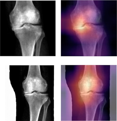 Grad-CAM interpretation of deep-learning-binary predictions. Grad-CAM heat mapping showing areas of highest activation for a control and case prediction made on the knee DEXA images. The regions of the map with the darkest color (purple) represent areas that were less informative in the prediction, while lighter colors (yellow) indicate regions of the image that informed the 'case' or 'control' prediction the most. We find areas of highest activation are most often on the medial side of the knee joint. Image courtesy of npj Digital Medicine through CC BY 4.0.
