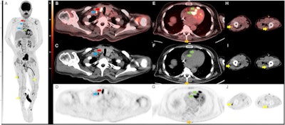 Selected images from the initial FDG-PET/CT. Coronal FDG PET maximum intensity projection (MIP; A) demonstrates multifocal FDG avid foci including a right thyroid nodule (red arrow), multiple supraclavicular, mediastinal, hilar, and mesenteric lymph nodes (blue arrow), multifocal nodular cardiac uptake (green arrow), and multiple nodular soft tissue deposits in the intramuscular fascia and skin (yellow arrow). Transaxial FDG-PET/CT (B) CT (C) and PET (D) images show a hypermetabolic nodule along the right thyroid gland which was a pathology proven to be sarcoidosis. Adjacent hypermetabolic right supraclavicular lymph node (blue arrow) was also noted and likely nodal sarcoid involvement. Transaxial FDG-PET/CT (E) CT (F) and PET (G) images through the thorax demonstrate nodular intense FDG uptake along the cardiac intraventricular septum (green arrow) and a nodular focus of cutaneous uptake along the back (orange arrow) which was found to be inflamed seborrheic keratoses. Transaxial FDG-PET/CT (H) CT (I) and PET (J) images through the legs demonstrate multinodular hypermetabolic focal (yellow arrow) along the intramuscular fascia and subcutaneous fat, which is also likely related to the patient sarcoid. Image courtesy of Radiology Case Reports through CC BY 4.0.