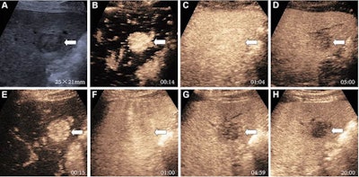 Ultrasound shows images of a 66-year-old male at risk for HCC due to hepatitis B virus infection and liver cirrhosis. Gray-scale ultrasound was initially examined. (A) Gray-scale image shows hypoechoic observation in segment VI measuring 25 x 21 mm (arrow). The participant underwent sulfur hexafluoride-enhanced ultrasound. (B) Arterial phase image at 14 seconds after injection shows nonrim hyperenhancement (arrow). (C) Portal venous phase image at 1:04 minutes does not show early washout (arrow). (D) Late-phase image at five minutes shows mild washout (arrow). The participant underwent evaluation by perfluorobutane-enhanced ultrasound on the same day. There was a minimum interval of 30 minutes between two examinations. (E) Arterial phase image at 15 seconds after injection shows nonrim hyperenhancement (arrow). (F) Portal venous phase image at one minute does not show early washout (arrow). (G) Late-phase image at 4:59 minutes shows late and mild washout (arrow). (H) Kupffer-phase image at 20 minutes shows mild Kupffer defect. The observation was classified as LI-RADS-5 regardless of the algorithms that were used. Pathologic diagnosis based on surgical resection was HCC. Images and caption courtesy of the RSNA.