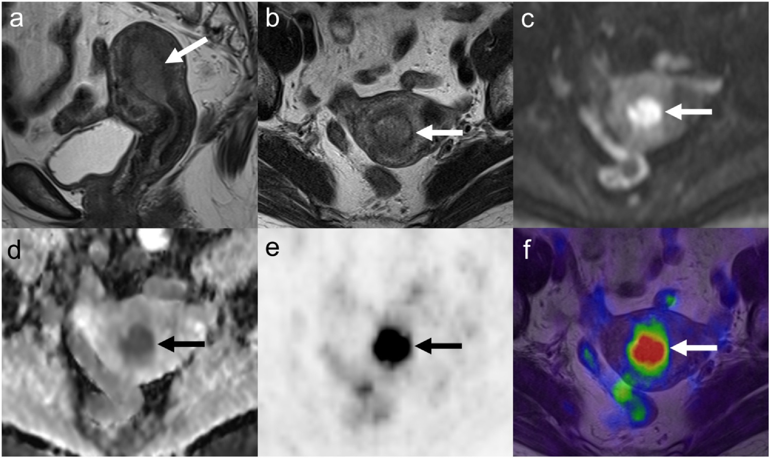 Images of a 69-year-old woman with endometrial cancer, grade 1 endometrioid adenocarcinoma, T1aN0M0, stage IA. Sagittal (a) and axial (b) T2-weighted MRI show an endometrial tumor (arrow), without deep myometrial invasion. The tumor (arrow) is hyperintense on diffusion-weighted imaging (c) and hypointense on the ADC map (d). The ADCmin of the tumor was 0.45 &times; 10&minus;3 mm2/s, and the ADCmean was 0.58 &times; 10&minus;3 mm2/s. PET (e) and PET/MRI fusion images (f) show intense FDG uptake of the tumor (arrow). The SUVmax of the tumor was 12.5, MTV was 3.9 mL, and TLG was 29 g.