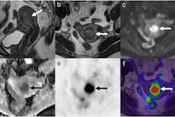 Images of a 69-year-old woman with endometrial cancer, grade 1 endometrioid adenocarcinoma, T1aN0M0, stage IA. Sagittal (a) and axial (b) T2-weighted MRI show an endometrial tumor (arrow), without deep myometrial invasion. The tumor (arrow) is hyperintense on diffusion-weighted imaging (c) and hypointense on the ADC map (d). The ADCmin of the tumor was 0.45 × 10−3 mm2/s, and the ADCmean was 0.58 × 10−3 mm2/s. PET (e) and PET/MRI fusion images (f) show intense FDG uptake of the tumor (arrow). The SUVmax of the tumor was 12.5, MTV was 3.9 mL, and TLG was 29 g.