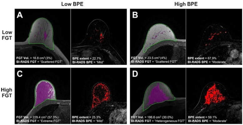 Examples of automatic fibroglandular tissue (FGT) segmentations on the precontrast (T1) non-fat saturated series and background parenchymal enhancement (BPE) extent on the postcontrast (T2) series for four control participants. For each participant, the left image shows the automated whole-breast segmentation (green line) and FGT segmentation (purple shading). The right image shows the areas of enhancement (red shading) within the FGT, defined as all voxels with 20% or more enhancement from the precontrast to postcontrast series. For each series, the middle section is presented. Example images were selected randomly within four categories defined by quantitative FGT volume (Vol) and BPE extent, where &ldquo;low&rdquo; refers to participants with measures in the bottom tertile and &ldquo;high&rdquo; refers to participants with measures in the top tertile. (A) Low FGT volume and low BPE extent in a 50-year-old premenopausal control participant. (B) Low FGT volume and high BPE extent in a 50-year-old control participant with a history of bilateral oophorectomy. (C) High FGT volume and low BPE extent in a 39-year-old premenopausal control participant. (D) High FGT volume and high BPE extent in a 44-year-old premenopausal control participant. Images and caption courtesy of the RSNA.
