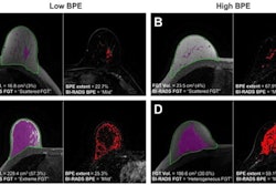 Examples of automatic fibroglandular tissue (FGT) segmentations on the precontrast (T1) non-fat saturated series and background parenchymal enhancement (BPE) extent on the postcontrast (T2) series for four control participants. For each participant, the left image shows the automated whole-breast segmentation (green line) and FGT segmentation (purple shading). The right image shows the areas of enhancement (red shading) within the FGT, defined as all voxels with 20% or more enhancement from the precontrast to postcontrast series. For each series, the middle section is presented. Example images were selected randomly within four categories defined by quantitative FGT volume (Vol) and BPE extent, where “low” refers to participants with measures in the bottom tertile and “high” refers to participants with measures in the top tertile. (A) Low FGT volume and low BPE extent in a 50-year-old premenopausal control participant. (B) Low FGT volume and high BPE extent in a 50-year-old control participant with a history of bilateral oophorectomy. (C) High FGT volume and low BPE extent in a 39-year-old premenopausal control participant. (D) High FGT volume and high BPE extent in a 44-year-old premenopausal control participant. Images and caption courtesy of the RSNA.