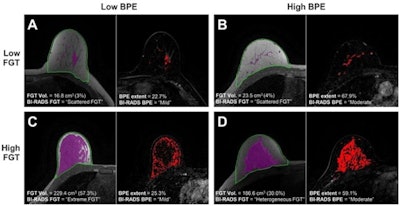 Examples of automatic fibroglandular tissue (FGT) segmentations on the precontrast (T1) non-fat saturated series and background parenchymal enhancement (BPE) extent on the postcontrast (T2) series for four control participants. For each participant, the left image shows the automated whole-breast segmentation (green line) and FGT segmentation (purple shading). The right image shows the areas of enhancement (red shading) within the FGT, defined as all voxels with 20% or more enhancement from the precontrast to postcontrast series. For each series, the middle section is presented. Example images were selected randomly within four categories defined by quantitative FGT volume (Vol) and BPE extent, where “low” refers to participants with measures in the bottom tertile and “high” refers to participants with measures in the top tertile. (A) Low FGT volume and low BPE extent in a 50-year-old premenopausal control participant. (B) Low FGT volume and high BPE extent in a 50-year-old control participant with a history of bilateral oophorectomy. (C) High FGT volume and low BPE extent in a 39-year-old premenopausal control participant. (D) High FGT volume and high BPE extent in a 44-year-old premenopausal control participant. Images and caption courtesy of the RSNA.