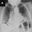 A representative posteroanterior chest x-ray (A) in a 71-year-old male patient who underwent examination due to progression of dyspnea shows bilateral fibrosis (arrows), which was misclassified as airspace disease by all four AI tools. Image courtesy of Radiology.