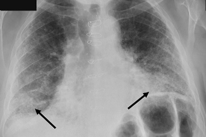 A representative posteroanterior chest x-ray (A) in a 71-year-old male patient who underwent examination due to progression of dyspnea shows bilateral fibrosis (arrows), which was misclassified as airspace disease by all four AI tools. Image courtesy of Radiology.