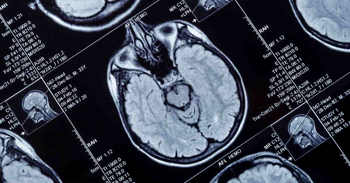 Mri Brain Head Social