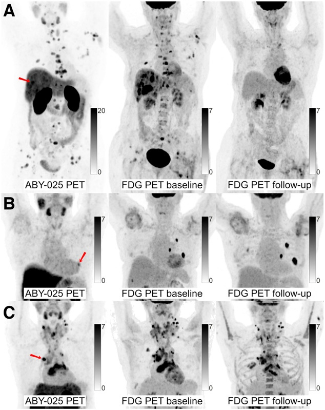 Ga-68 ABY-025 PET/CT and F-18 FDG-PET/CT images at baseline with F-18 FDG PET/CT follow-up after two cycles of treatment in biopsy-confirmed HER2-positive disease. (A) Patient with high Ga-68 ABY-025 uptake (SUVmax, 21), who previously received three lines of treatment. F-18 FDG-PET/CT follow-up showed complete metabolic response. (B) Patient with low uptake (SUVmax, 5.4), who previously received three lines of treatment. F-18 FDG PET/CT follow-up showed disease progression (a 68% increase in tumor glycolysis) despite HER2-targeted treatment. (C) Patient with heterogeneous Ga-68 ABY-025 uptake, who previously received seven lines of treatment. F-18 FDG-PET/CT follow-up showed heterogeneous response, with lesions higher in Ga-68 ABY-025 uptake tending to have better response. Arrows indicate biopsy sites. Image courtesy of the Journal of Nuclear Medicine.
