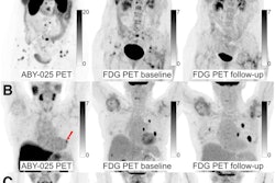 Ga-68 ABY-025 PET/CT and F-18 FDG-PET/CT images at baseline with F-18 FDG PET/CT follow-up after two cycles of treatment in biopsy-confirmed HER2-positive disease. (A) Patient with high Ga-68 ABY-025 uptake (SUVmax, 21), who previously received three lines of treatment. F-18 FDG-PET/CT follow-up showed complete metabolic response. (B) Patient with low uptake (SUVmax, 5.4), who previously received three lines of treatment. F-18 FDG PET/CT follow-up showed disease progression (a 68% increase in tumor glycolysis) despite HER2-targeted treatment. (C) Patient with heterogeneous Ga-68 ABY-025 uptake, who previously received seven lines of treatment. F-18 FDG-PET/CT follow-up showed heterogeneous response, with lesions higher in Ga-68 ABY-025 uptake tending to have better response. Arrows indicate biopsy sites. Image courtesy of the Journal of Nuclear Medicine.