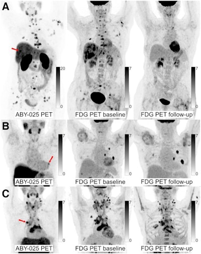 Ga-68 ABY-025 PET/CT and F-18 FDG-PET/CT images at baseline with F-18 FDG PET/CT follow-up after two cycles of treatment in biopsy-confirmed HER2-positive disease. (A) Patient with high Ga-68 ABY-025 uptake (SUVmax, 21), who previously received three lines of treatment. F-18 FDG-PET/CT follow-up showed complete metabolic response. (B) Patient with low uptake (SUVmax, 5.4), who previously received three lines of treatment. F-18 FDG PET/CT follow-up showed disease progression (a 68% increase in tumor glycolysis) despite HER2-targeted treatment. (C) Patient with heterogeneous Ga-68 ABY-025 uptake, who previously received seven lines of treatment. F-18 FDG-PET/CT follow-up showed heterogeneous response, with lesions higher in Ga-68 ABY-025 uptake tending to have better response. Arrows indicate biopsy sites. Image courtesy of the Journal of Nuclear Medicine.