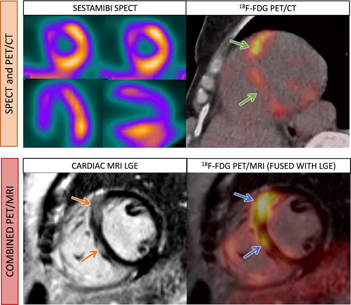 Images in a 52-year-old woman with cardiac sarcoidosis. Standard-of-care imaging (top row) demonstrates a perfusion defect on SPECT images (top left) and corresponding FDG radiotracer uptake on PET/CT image (top right) at the interventricular septum (green arrows). On combined F-18 FDG-PET/MRI (bottom row), there is nodular late gadolinium enhancement (LGE) at the interventricular septum (orange arrows) with corresponding FDG uptake (blue arrows). Image courtesy of Radiology: Cardiothoracic Imaging.