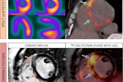 Images in a 52-year-old woman with cardiac sarcoidosis. Standard-of-care imaging (top row) demonstrates a perfusion defect on SPECT images (top left) and corresponding FDG radiotracer uptake on PET/CT image (top right) at the interventricular septum (green arrows). On combined F-18 FDG-PET/MRI (bottom row), there is nodular late gadolinium enhancement (LGE) at the interventricular septum (orange arrows) with corresponding FDG uptake (blue arrows). Image courtesy of Radiology: Cardiothoracic Imaging.
