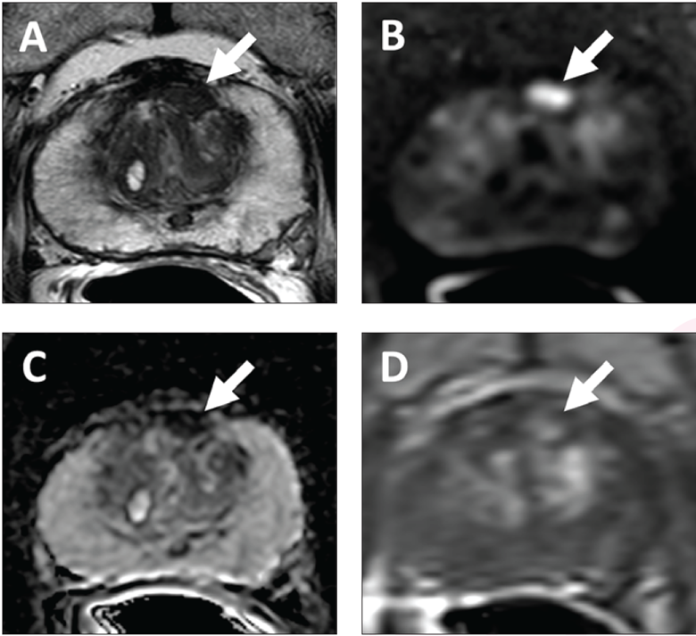 62-year-old patient with serum PSA level of 4.11 ng/mL. Prostate MRI shows lesion in left midanterior transition zone. Lesion (arrow) shows hypointensity on T2-weighted image (A), hyperintensity on high b-value DWI (B), hypointensity on ADC map (C), and focal early enhancement on dynamic contrast-enhanced image (D). Lesion was assessed as category 4 using PI-RADS version 2.1 MRI-targeted biopsy of lesion revealed prostate adenocarcinoma with ISUP grade group 2. At subsequent radical prostatectomy performed 6 months after biopsy, ISUP grade group was upgraded to 3. ISUP, International Society of Urogenital Pathology. Image courtesy of AJR.