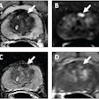 62-year-old patient with serum PSA level of 4.11 ng/mL. Prostate MRI shows lesion in left midanterior transition zone. Lesion (arrow) shows hypointensity on T2-weighted image (A), hyperintensity on high b-value DWI (B), hypointensity on ADC map (C), and focal early enhancement on dynamic contrast-enhanced image (D). Lesion was assessed as category 4 using PI-RADS version 2.1 MRI-targeted biopsy of lesion revealed prostate adenocarcinoma with ISUP grade group 2. At subsequent radical prostatectomy performed 6 months after biopsy, ISUP grade group was upgraded to 3. ISUP, International Society of Urogenital Pathology. Image courtesy of AJR.