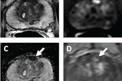 62-year-old patient with serum PSA level of 4.11 ng/mL. Prostate MRI shows lesion in left midanterior transition zone. Lesion (arrow) shows hypointensity on T2-weighted image (A), hyperintensity on high b-value DWI (B), hypointensity on ADC map (C), and focal early enhancement on dynamic contrast-enhanced image (D). Lesion was assessed as category 4 using PI-RADS version 2.1 MRI-targeted biopsy of lesion revealed prostate adenocarcinoma with ISUP grade group 2. At subsequent radical prostatectomy performed 6 months after biopsy, ISUP grade group was upgraded to 3. ISUP, International Society of Urogenital Pathology. Image courtesy of AJR.