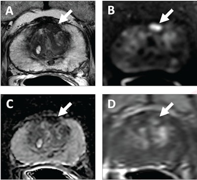 62-year-old patient with serum PSA level of 4.11 ng/mL. Prostate MRI shows lesion in left midanterior transition zone. Lesion (arrow) shows hypointensity on T2-weighted image (A), hyperintensity on high b-value DWI (B), hypointensity on ADC map (C), and focal early enhancement on dynamic contrast-enhanced image (D). Lesion was assessed as category 4 using PI-RADS version 2.1 MRI-targeted biopsy of lesion revealed prostate adenocarcinoma with ISUP grade group 2. At subsequent radical prostatectomy performed 6 months after biopsy, ISUP grade group was upgraded to 3. ISUP, International Society of Urogenital Pathology. Image courtesy of AJR.