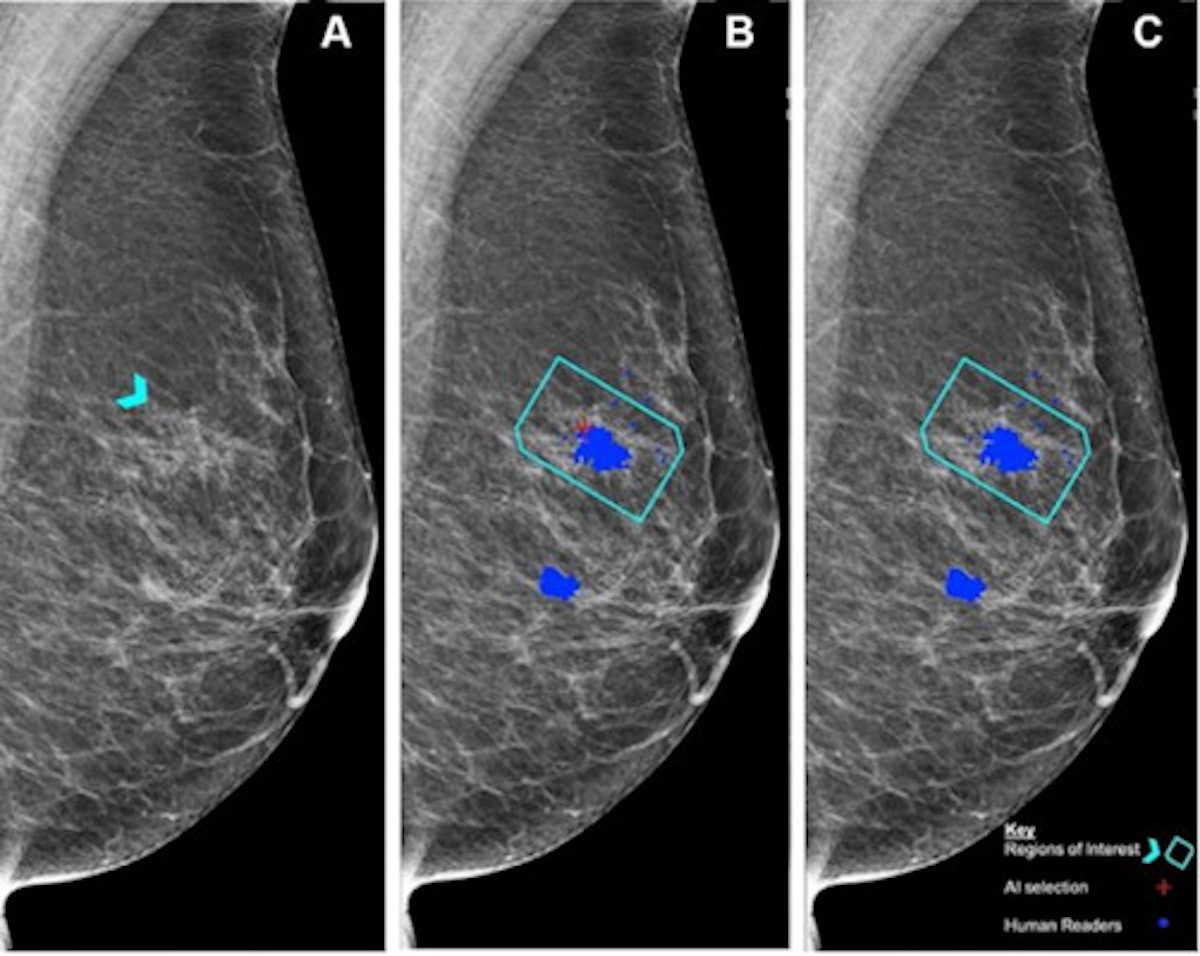 Normal breast MRI - dense breasts, Radiology Case
