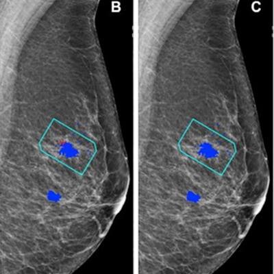 AI has helped radiologists detect 20% more cases of breast cancer