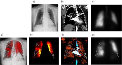 Images of a 50-year-old woman with acute pulmonary embolism. Normal findings are shown in the chest radiograph (a) and anterior planar ventilation scintigraphy (c), whereas the coronal view of the CT pulmonary angiography shows large blood clots in the bilateral pulmonary arteries (b, arrows). Multiple wedge-shaped perfusion defects (dotted triangles) are demonstrated in the bilateral lungs in perfusion images obtained using the cross-correlation method (d) and reference frame subtraction method (e) of dynamic chest radiography, an iodine map created from computed tomography pulmonary angiography (f), and anterior planar perfusion scintigraphy (g). Image and caption courtesy of Radiology: Cardiothoracic Imaging through CC BY 4.0.