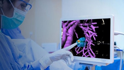 The view using Techsomed's VisAble.IO 3D ablation software. Image courtesy of Techsomed.