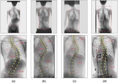 Results of Cobb angle measurements using the proposed method. The upper row shows the detected region of interest (indicated by a rectangle on the image) and the lower row shows the Cobb angle measurement results. Each column shows examples of (a) standing, (b) supine, (c) bending, and (d) wearing-brace x-ray images. Image courtesy of Scientific Reports through CC BY 4.0.