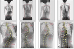 2023 09 07 15 32 2438 2023 09 07 Scoliosis 400