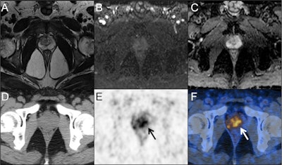 A 55-year-old man presented with a persistently elevated prostate-specific antigen (PSA) range of 4.37-6.82 ng/ml over a period of one year. Magnetic resonance imaging (MRI) (A, T2-weight imaging; B, DWI imaging; C, ADC map) didn't reveal the presence of any malignant lesions. PET/CT images (D, CT; E, PET; F, fusion) showed intensive prostate-specific membrane antigen (PSMA) uptake in the center gland and right periphery of the prostate (arrows). According to the predictive model, the probability of clinically significant prostate cancer for this lesion is 0.67 (> 0.35). Subsequent prostate biopsy result in a Gleason score 4 + 3 prostate cancer. Image courtesy of Cancer Imaging through CC BY 4.0.