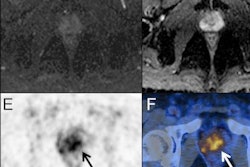 2023 09 08 15 10 4007 2023 09 08 Prostate Cancer 20230908154926