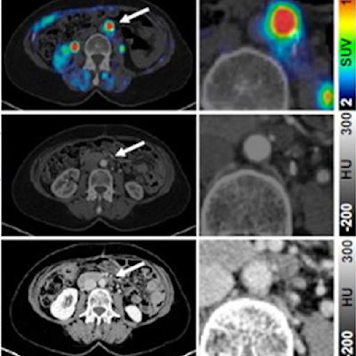 FAPI-PET/CT may improve treatment of cancer patients | AuntMinnie