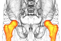 Femur And Pelvis 400