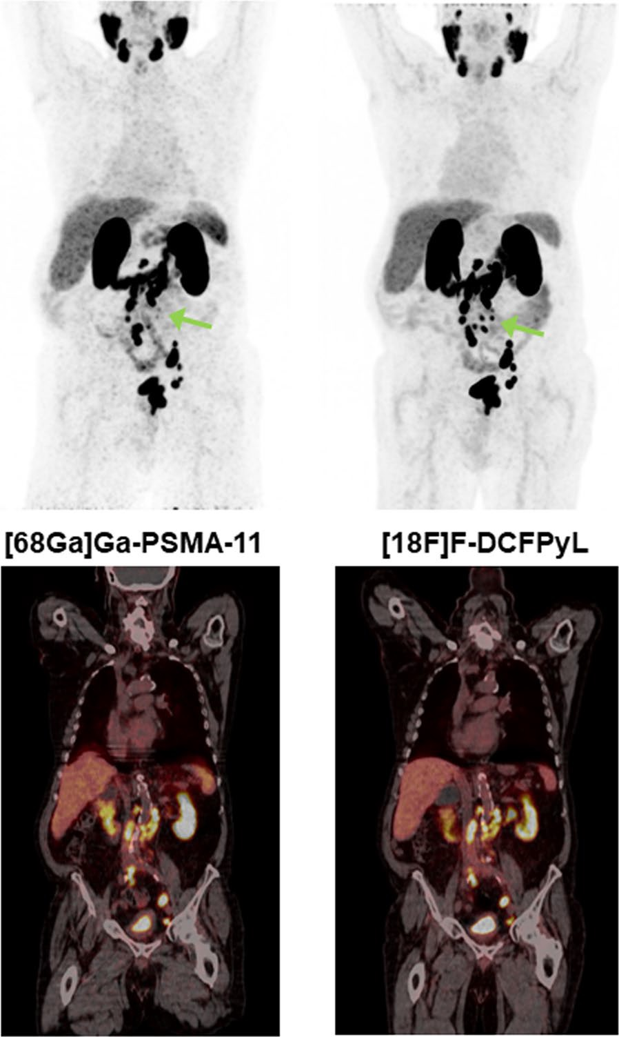 PSMA-PET imaging