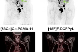 PSMA-PET imaging