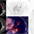 Hybrid contrast-enhanced CT (with iodinated contrast bolus timed to maximize pulmonary arterial visualization) and F-18 DCFPyL PSMA-PET images. Contrast CT images (A, B) show an eccentric filling defect in the superior lingula segmental artery of the left lung upper lobe (red arrow). This is concordant with moderately intense PSMA radiotracer expression (black arrows on axial PET-only images, C, and on whole-body maximum intensity projection image, E). Fused PET and contrast-enhanced CT axial image (D) also confirm the lesion (red arrow). No other site of PSMA expressing metastasis is evident on whole-body imaging (E).