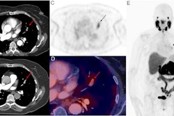 Hybrid contrast-enhanced CT (with iodinated contrast bolus timed to maximize pulmonary arterial visualization) and F-18 DCFPyL PSMA-PET images. Contrast CT images (A, B) show an eccentric filling defect in the superior lingula segmental artery of the left lung upper lobe (red arrow). This is concordant with moderately intense PSMA radiotracer expression (black arrows on axial PET-only images, C, and on whole-body maximum intensity projection image, E). Fused PET and contrast-enhanced CT axial image (D) also confirm the lesion (red arrow). No other site of PSMA expressing metastasis is evident on whole-body imaging (E).