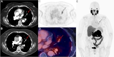 Hybrid contrast-enhanced CT (with iodinated contrast bolus timed to maximize pulmonary arterial visualization) and F-18 DCFPyL PSMA-PET images. Contrast CT images (A, B) show an eccentric filling defect in the superior lingula segmental artery of the left lung upper lobe (red arrow). This is concordant with moderately intense PSMA radiotracer expression (black arrows on axial PET-only images, C, and on whole-body maximum intensity projection image, E). Fused PET and contrast-enhanced CT axial image (D) also confirm the lesion (red arrow). No other site of PSMA expressing metastasis is evident on whole-body imaging (E). Hybrid contrast-enhanced CT (with iodinated contrast bolus timed to maximize pulmonary arterial visualization) and F-18 DCFPyL PSMA-PET images. Contrast CT images (A, B) show an eccentric filling defect in the superior lingula segmental artery of the left lung upper lobe (red arrow). This is concordant with moderately intense PSMA radiotracer expression (black arrows on axial PET-only images, C, and on whole-body maximum intensity projection image, E). Fused PET and contrast-enhanced CT axial image (D) also confirm the lesion (red arrow). No other site of PSMA expressing metastasis is evident on whole-body imaging (E).