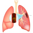 Pulmonary Embolism Illustration 400